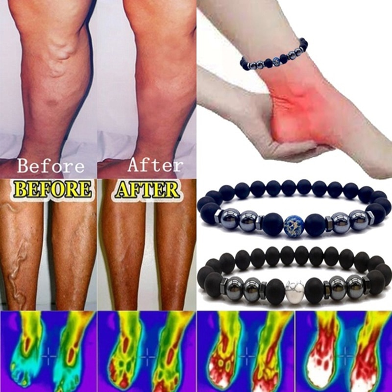 Anti Varicose And Swelling Magnetotherapy Anklet