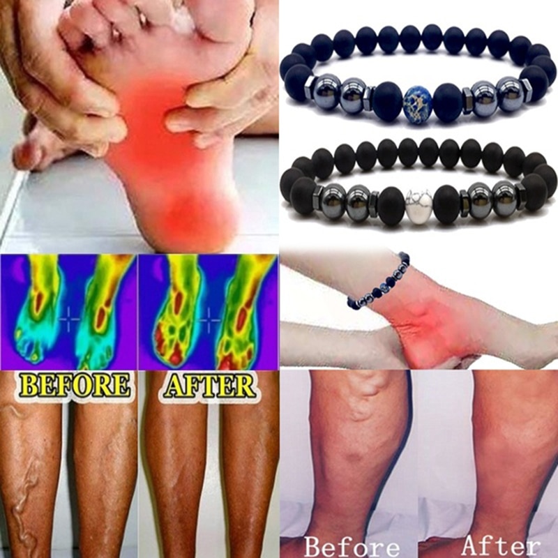 Anti Varicose And Swelling Magnetotherapy Anklet