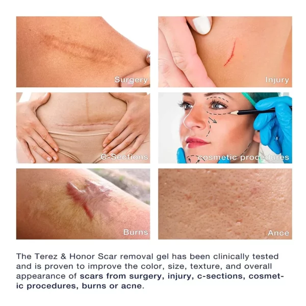 MEDix Advanced Silicone Scar Gel