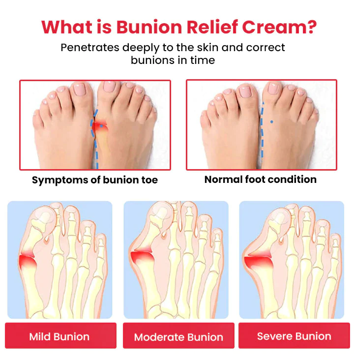 DigiEase Bunions Relief Cream