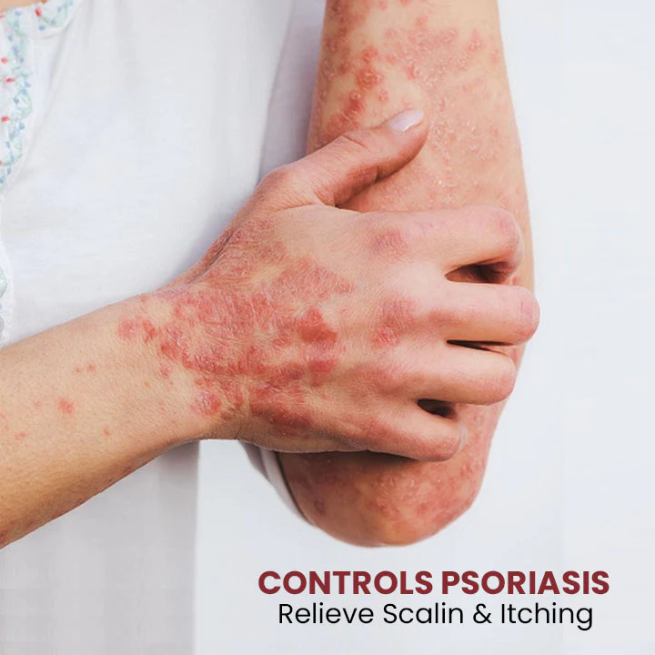 Medipure Psoriasis Relief Spray