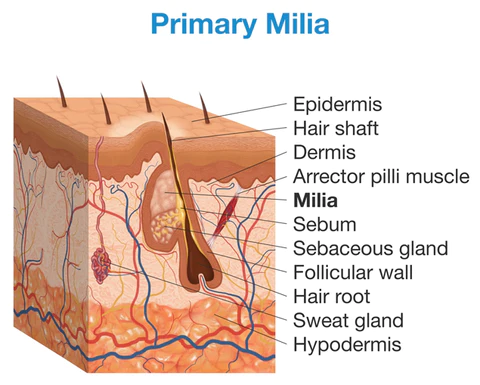 DermaPRO Speedy Milia Remover