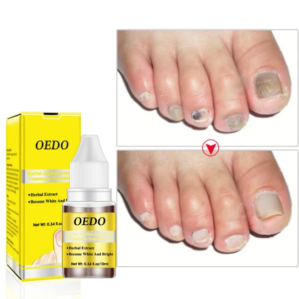 Herbal Nail Treatments Essential Oil