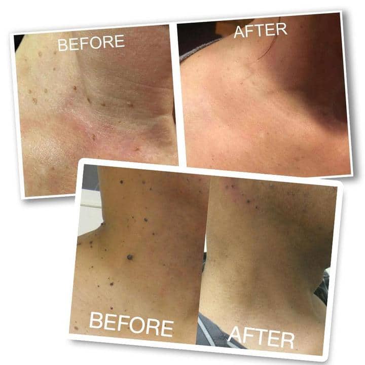 OFFImperfections Upgraded Skin Tag Removal