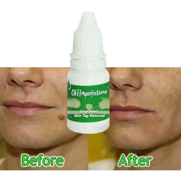 OFFImperfections Upgraded Skin Tag Removal