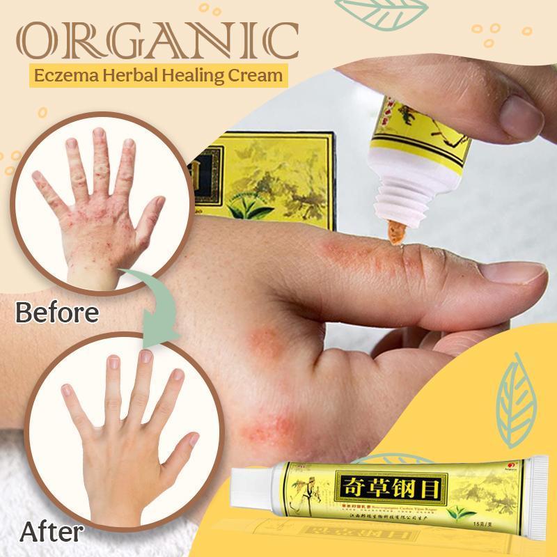 Organic Dermatitis Herbal Healing Cream