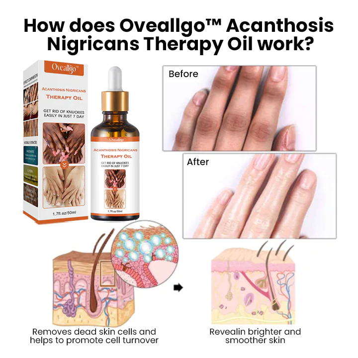 Oveallgo Acanthosis Nigricans Therapy Oil