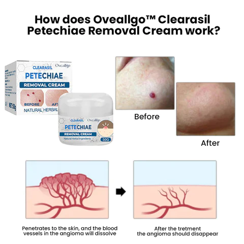 Oveallgo Clearasil Petechiae Removal Cream