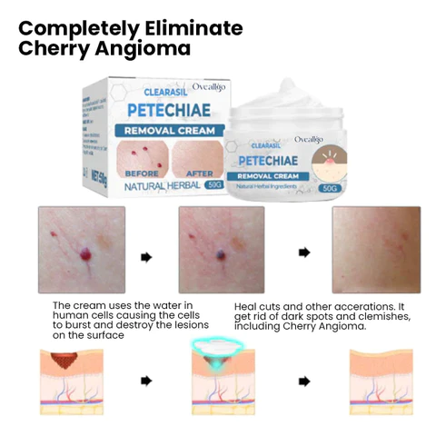 Oveallgo Clearasil Petechiae Removal Cream