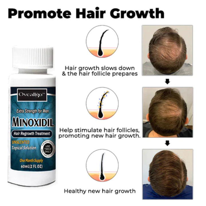 Oveallgo Minoxidil Hair Regrowth Treatment