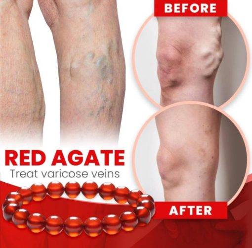 Red Agate Varicose Vein Cure Anklet