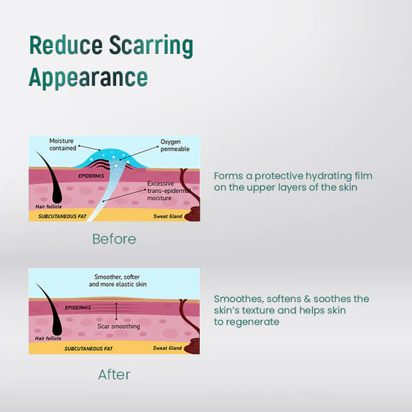 ScarXpert Advanced Scar Removal Gel