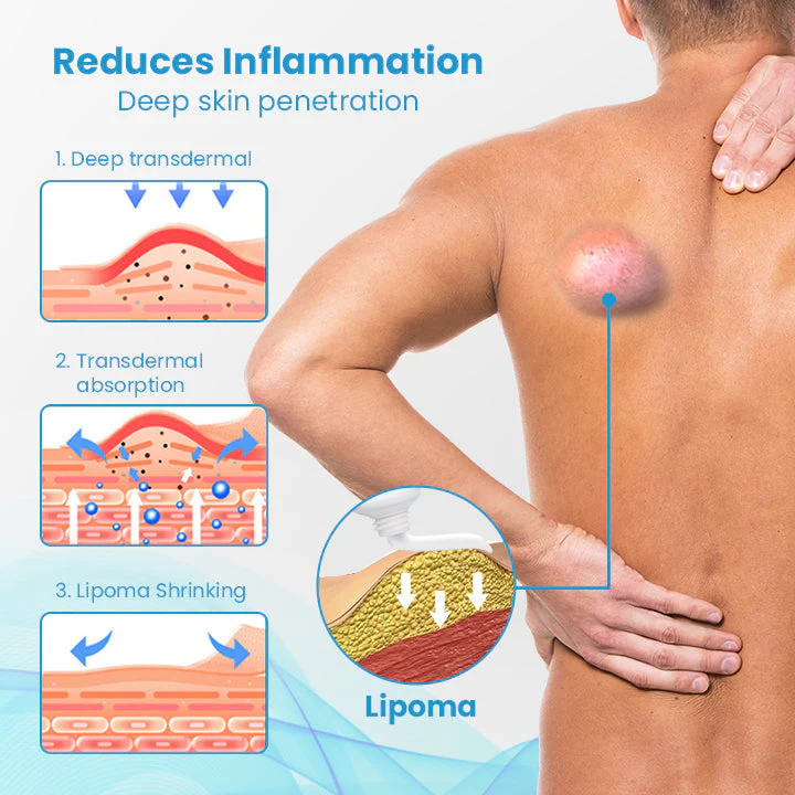 HEALumps Lipoma Treatment Ointment