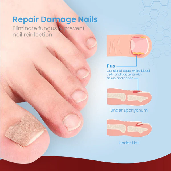 ToenailPro German Paronychia Relief Patch