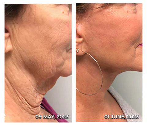 GFOUK Neck Goiter and Firming Therapy Serum