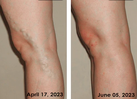 ATTDX Varicose Veins Treatment Cream