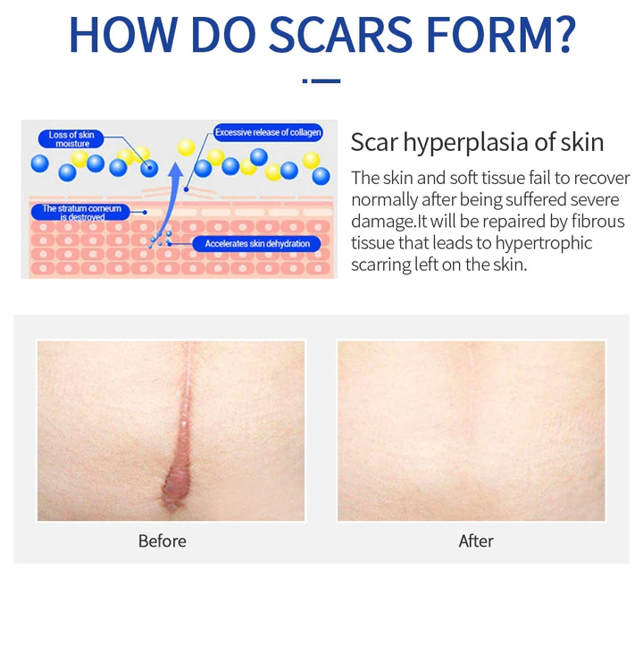 High Purity Silicone Scar Treatment Gel