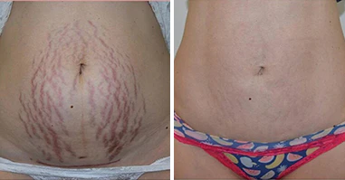 flysmus 7 Days Marks Fading Treatment Set