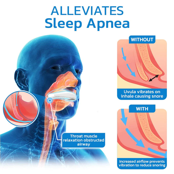 GFOUK WellSleep Apnea Oral Appliances