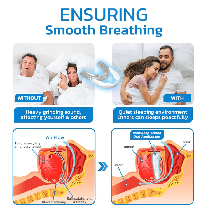 GFOUK WellSleep Apnea Oral Appliances