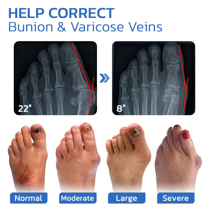 GFOUK AntiBunion and VeinHeal Health Socks