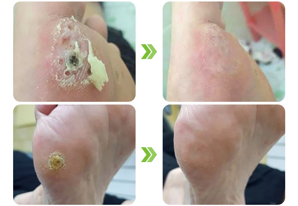 Oveallgo IHerbal Foot Callus And Corns Removal Soak