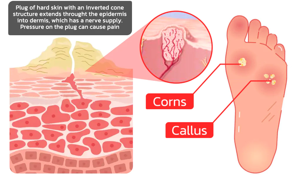 Oveallgo IHerbal Foot Callus And Corns Removal Soak