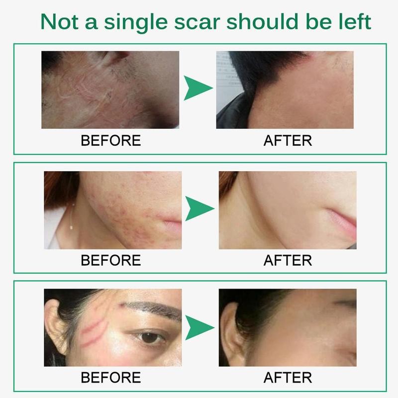 Intensive Scar Removal Cream