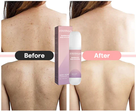 Oveallgo BackBeautify Body Acne Killer