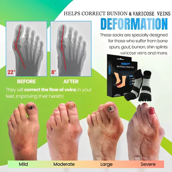 Sofeet Anti Bunions & Varicose Veins Health Sock