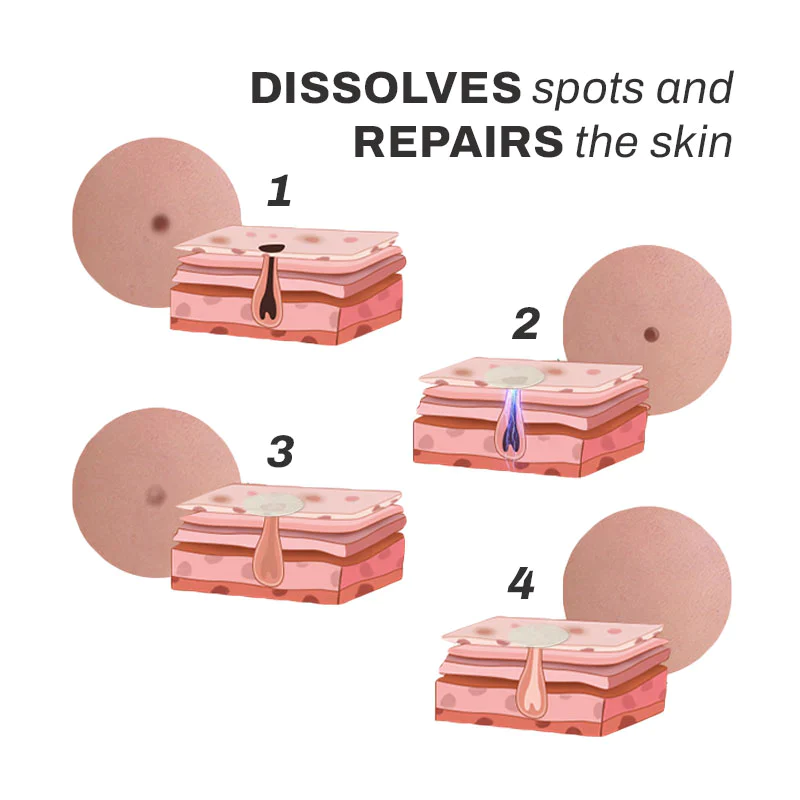 SpotOff SkinTag RemoverPatches