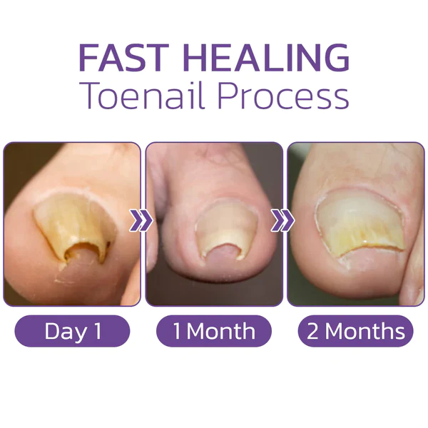 Japanese Elastic Toenail Correction Patch