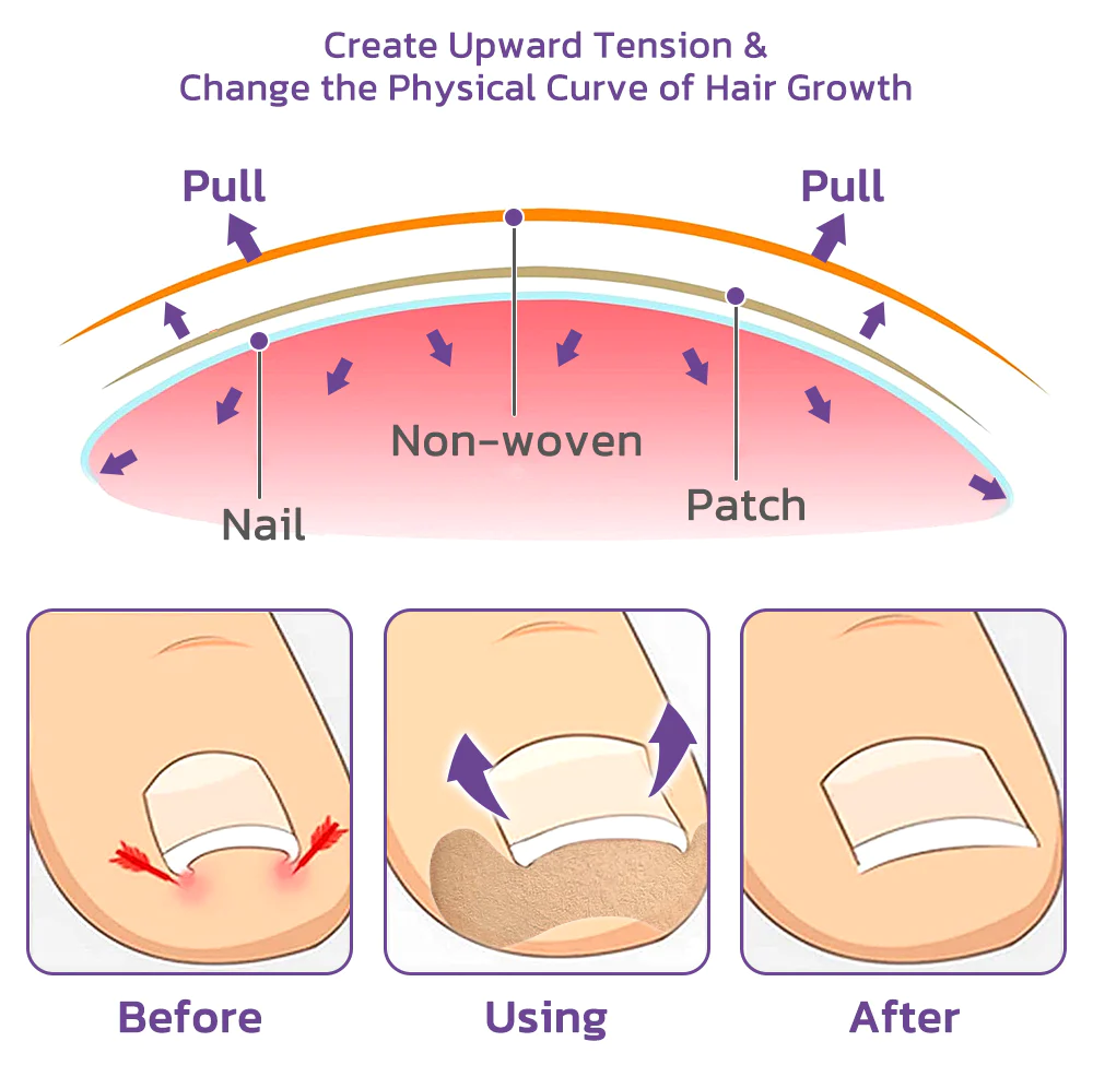 Japanese Elastic Toenail Correction Patch