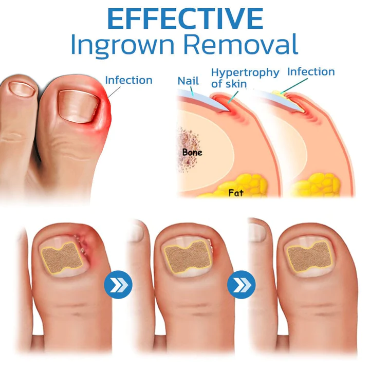 AEXZR Paronychia Correcting Patch