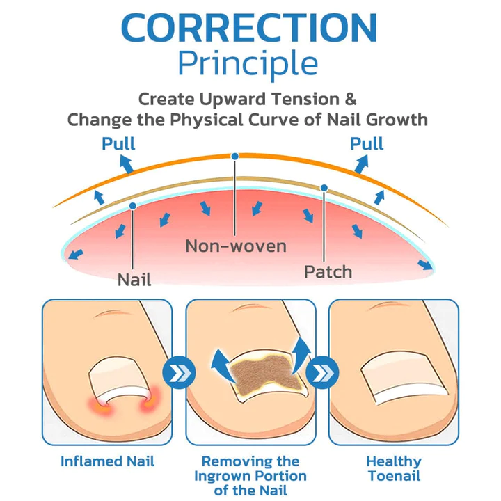 AEXZR Paronychia Correcting Patch