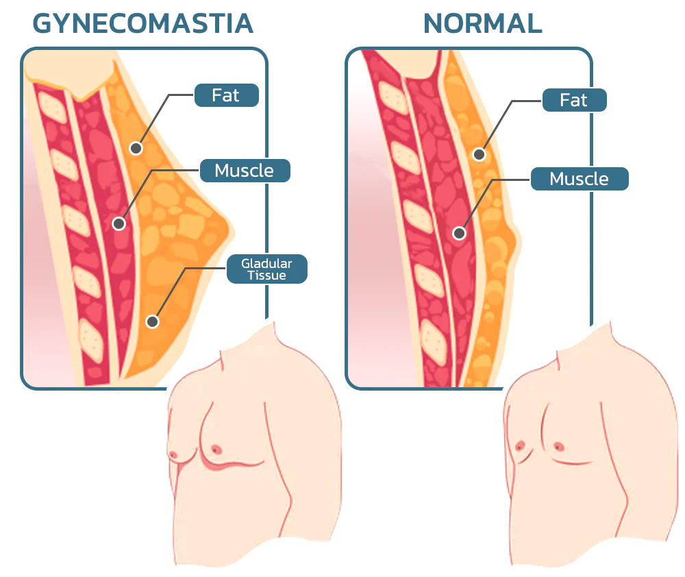 Gynecomastia Compress Far Infrared-Shaping Tank Top