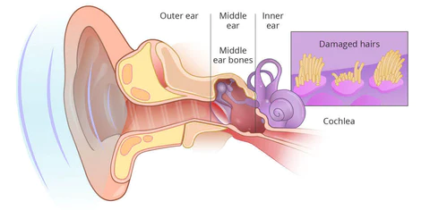 GERMAN SonoPro Tinnitus Relief Treatment Ear Patch