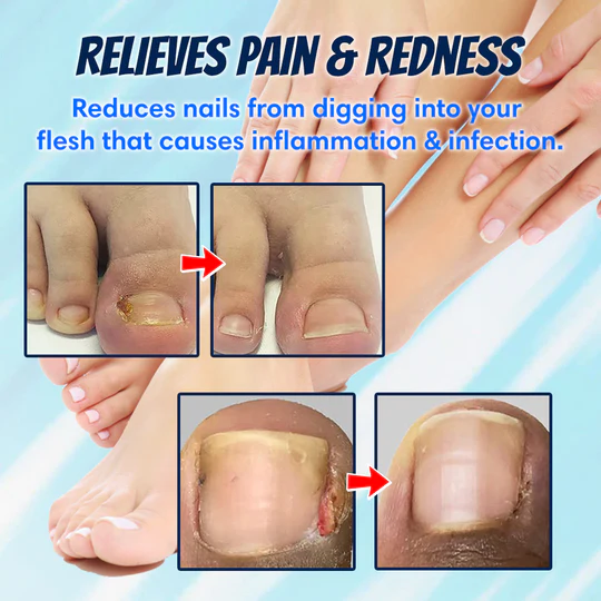 Ingrown Toenail Correction Patch