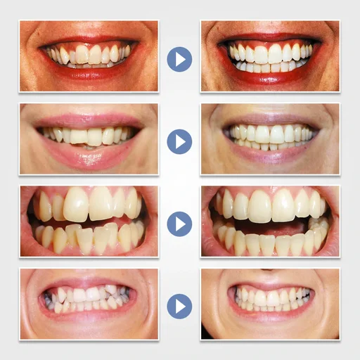 Tooth Orthodontic Braces