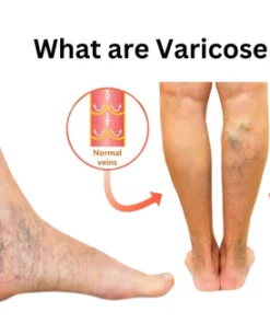 Oveallgo VeinHealing Varicose Veins Treatment Spray