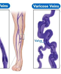 VeinHealthy Varicose Veins Spray