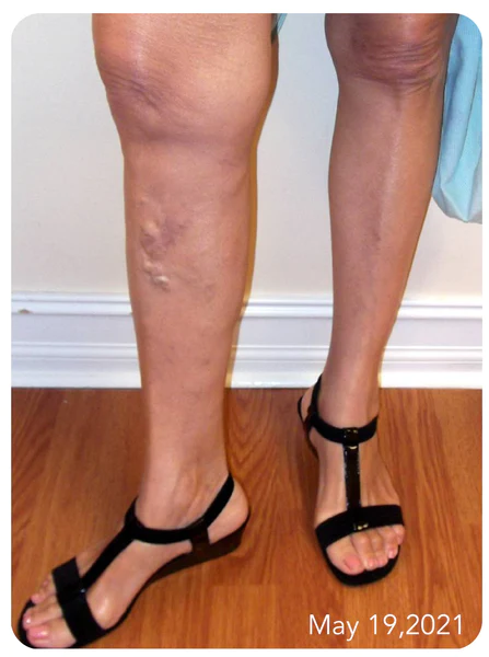 VeinHealthy Varicose Veins Spray