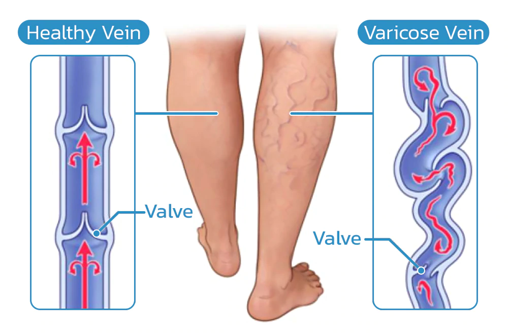 Dr.Vein Varicose Treatment Spray