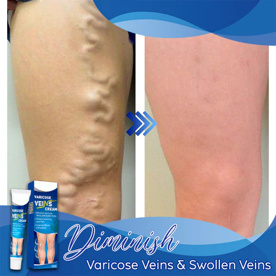 Veins Gone Smoothing Cream