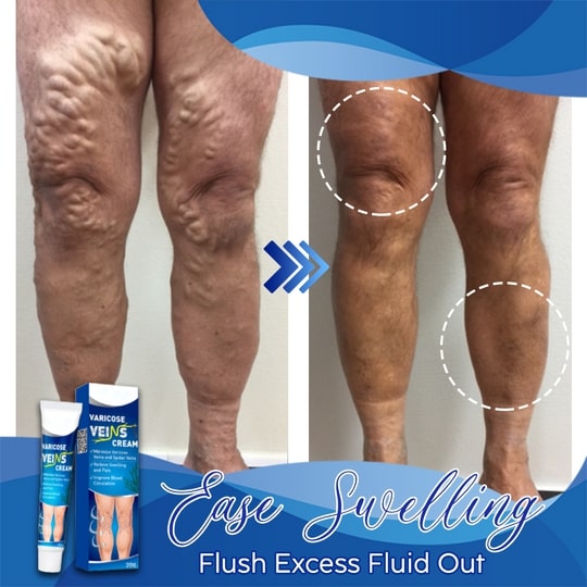 Varicose Veins Cream