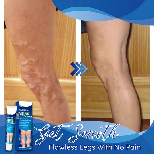 Varicose Veins Cream