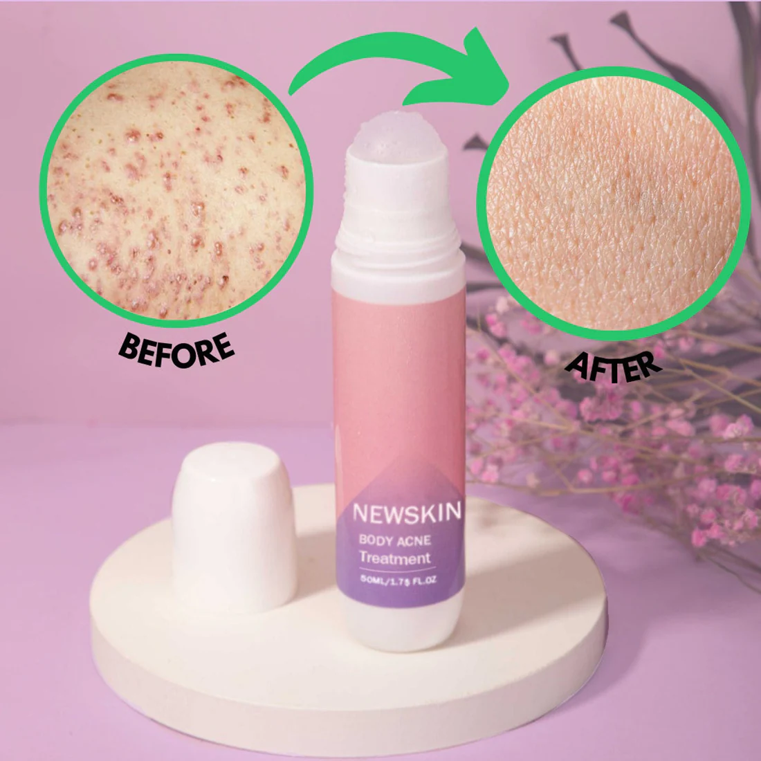 NEWSKIN Pimple & Acne Treatment Roll On Serum