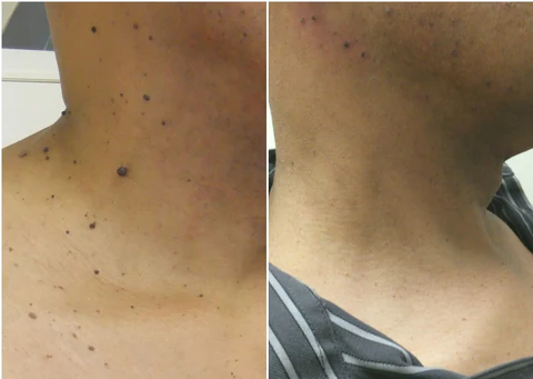 Organic SkinTag Solution