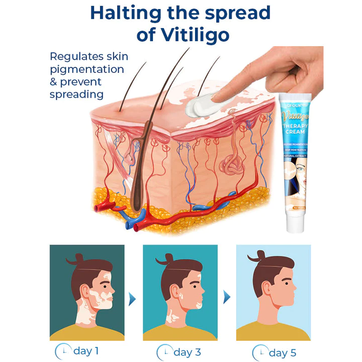 GFOUK Vitiligo Therapy Cream