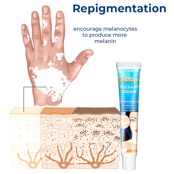 GFOUK Vitiligo Therapy Cream